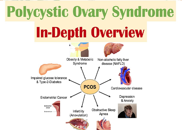 Polycystic Ovarian Syndrome Management